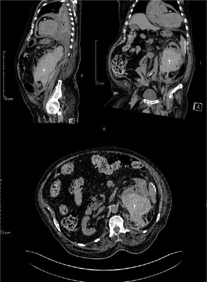 Figure 2 CT abdomen (non-contrast) showing hematoma in the renal mass (white arrow) with distortion of the renal cortex (black arrow) in the sagittal (top-left), coronal (top-right) and transverse (bottom) planes.