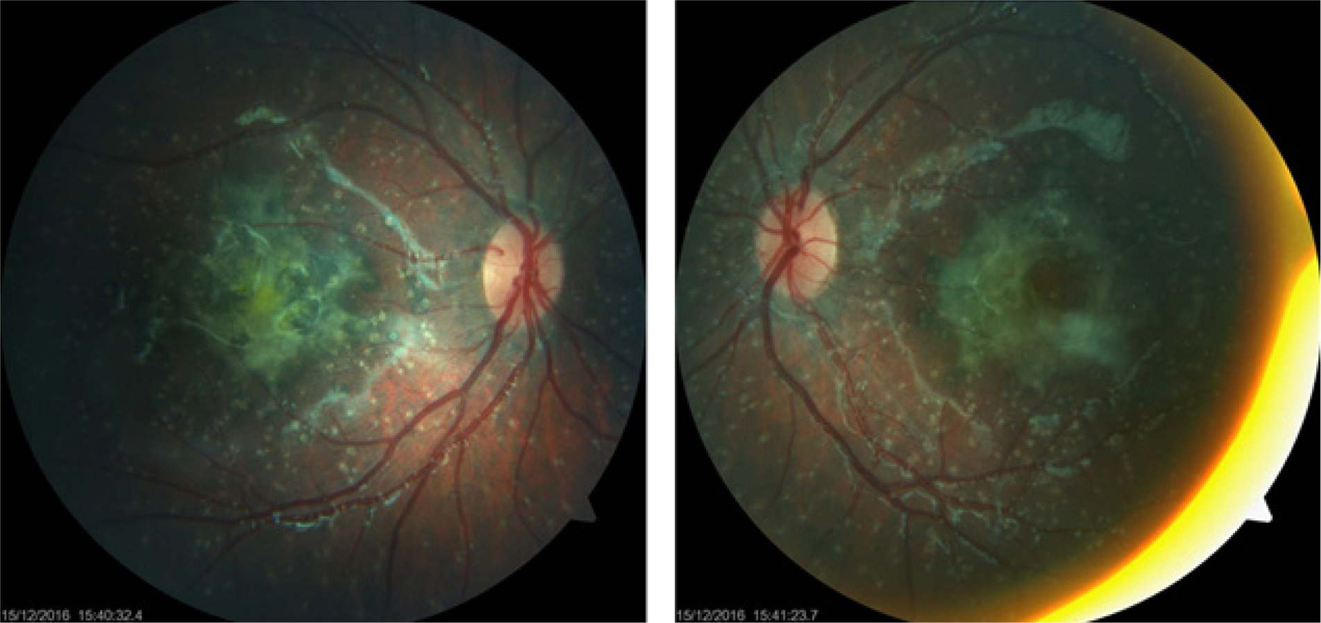 Figure 2: Bottom of eye : black-brown scar with white punctiform deposits all over the retina