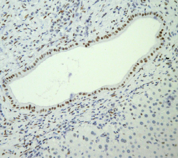 Figure 1 Intense nuclear immunostaining is seen in a bile duct from a biopsy of a PBC patient (Initial magnification 200×).