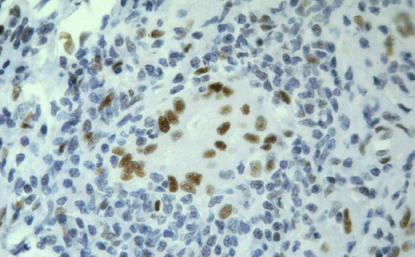 Figure 2 Intense and diffuse nuclear staining of ductal epithelial cells in an interlobular bile duct in a case of PBC (Original magnification 400×).