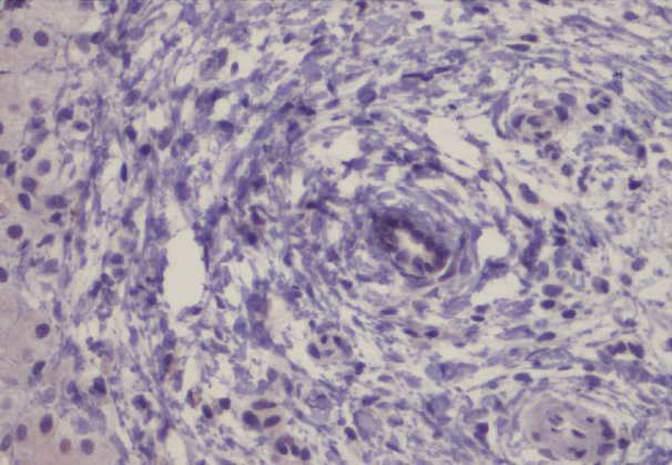 Figure 3 No immunostaining for PML is seen in a case of PSC that included an interlobular bile duct with periductal fibrosis (Original magnification 400×).