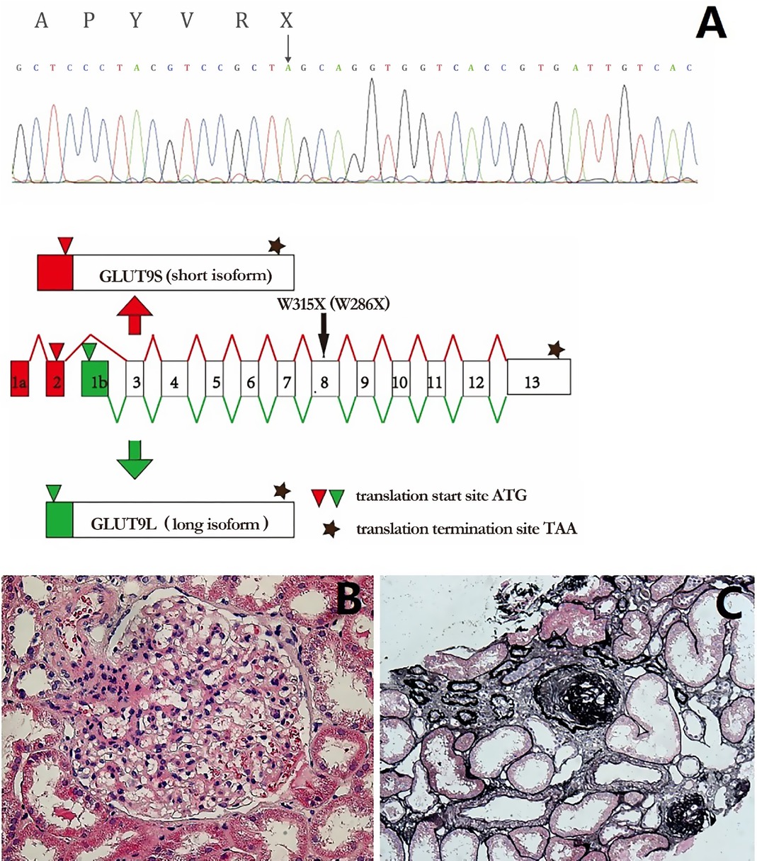 Figure 1 Molecular characterization and renal histology of the patient. A. Homozygous nonsense mutation c.944G > A (NM_020041, GLUT9L)/c.857G > A (NM_001001290, GLUT9S), illustrated by black arrow, led to truncated protein p. W315X (NP_064425.2, GLUT9L)/p. W286X (NP_001001290.1, GLUT9S). B. Marked glomerular hypertrophy with a mean diameter of 240 μm. C. Global sclerosis (9.7%) with focal tubular atrophy and interstitial fibrosis (PASM, ×100).