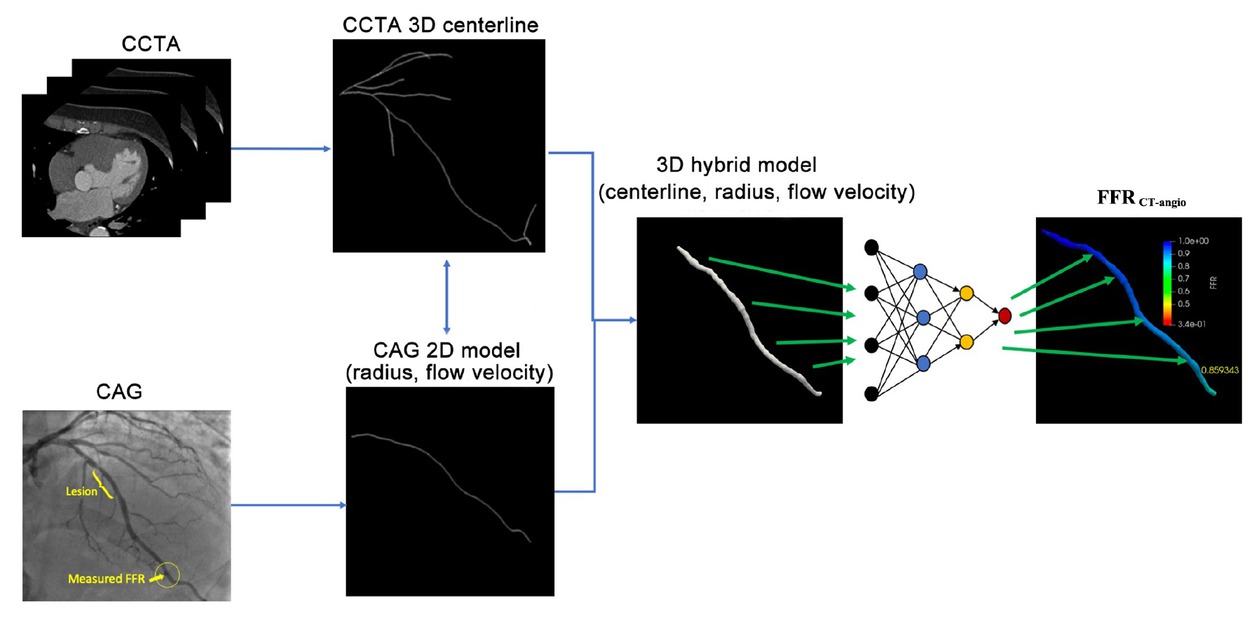 Figure 1 FFRCT-angio flow chart. CAG: coronary angiography; CCTA: coronary CT angiography; FFR: fractional flow reserve; 3D: three dimensional; 2D: two dimensional.