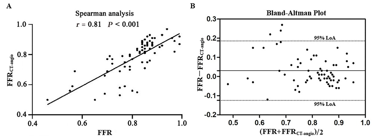 Figure 3 Correlation and agreement between FFRCT-angio and FFR. (A) Scatter plots of the Spearman analysis show a good correlation between invasive FFR and FFRCT-angio. (B) Bland–Altman plots illustrate the mean difference (solid line) between FFR and FFRCT-angio with 95% LoA (dashed lines). FFR: fractional flow reserve; FFR CT-angio: fractional flow reserve derived from integrated coronary CT angiography and invasive angiography; LoA: limit of agreement.