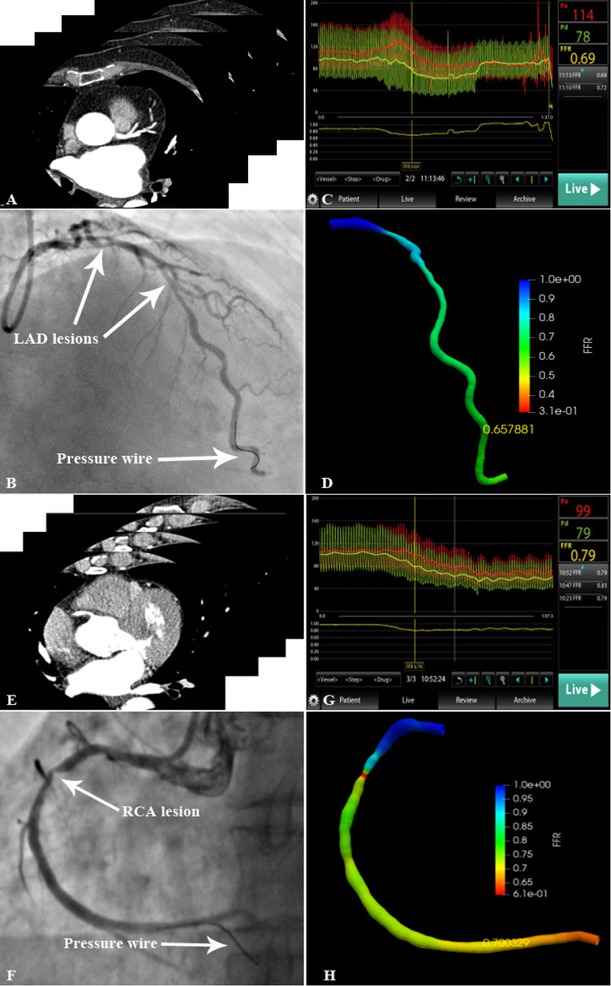 Figure 4 Representative lesions assessed by invasive FFR and FFRCT-angio (A) CCTA scan of LAD. (B) LAD lesion and pressure wire location are shown in the angiogram. (C) The FFR value measured using the pressure wire was 0.69. (D) 3D reconstruction of the LAD based on the integration of CAG and CCTA images. The FFRCT-angio value was highly correlated with the FFR value (FFRCT-angio = 0.66). (E) CCTA scan of RCA. (F) RCA lesion and pressure wire location are shown in the angiogram. (G) The FFR value measured using the pressure wire was 0.79. (H) 3D reconstruction of the RCA based on the integration of CAG and CCTA images. The FFRCT-angio value was highly correlated with the FFR value (FFRCT-angio = 0.70). CAG: coronary angiography; CCTA: coronary CT angiography; FFR: fractional flow reserve; LAD: left anterior descending artery; FFRCT-angio: fractional flow reserve derived from integrated CT angiography and invasive angiography; RCA: right coronary artery; 3D: three dimensional.