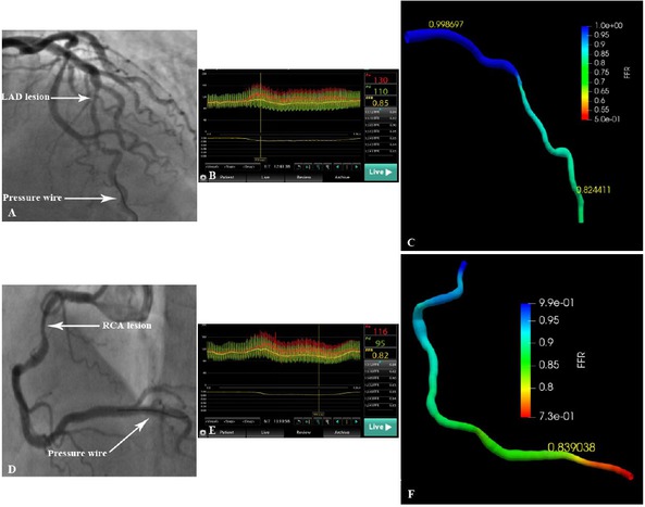 Figure 6 Reconstruction and hemodynamic assessment of coronary arteries with severe overlap or tortuosity by FFRCT-angio. (A) Inability to reconstruct the LAD using angiographic images due to severe vessel overlap. (B) The FFR value measured using the pressure wire was 0.85. (C) Successful reconstruction of the LAD and subsequent FFR calculation using the integration of CCTA and CAG images (FFRCT-angio = 0.82). (D) Inability to reconstruct the RCA using angiographic images due to severe tortuosity. (E) The FFR value measured using the pressure wire was 0.82. (F) Successful reconstruction of the RCA and subsequent FFR calculation using the integration of CCTA and CAG images (FFRCT-angio = 0.84). CAG: coronary angiography; CCTA: coronary CT angiography; FFR: fractional flow reserve; LAD: left anterior descending artery; FFRCT-angio: fractional flow reserve derived from integrated CT angiography and invasive angiography; RCA: right coronary artery.