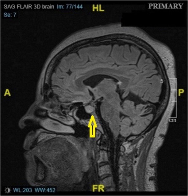 Figure 1 MRI scan of the patient showing pituitary enhancement (yellow arrow). MRI: magnetic resonance imaging. A: anterior; P: posterior; HL: head length; FR: frequency.