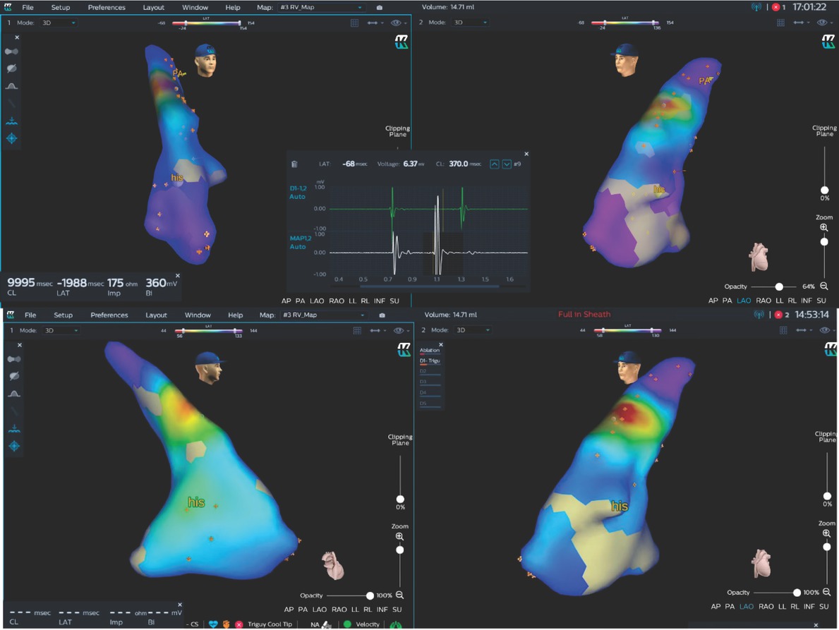 Figure 1 KODEX map of one patient with ventricular premature beats. The anatomic map of RVOT and right ventricle were plotted. The earliest target was clearly located at the septum of RVOT, with early fragmentation potential in the ECG lead window. After two seconds of ablation, ventricular premature beats disappeared. his: His bundle; RVOT: right ventricular outflow tract.