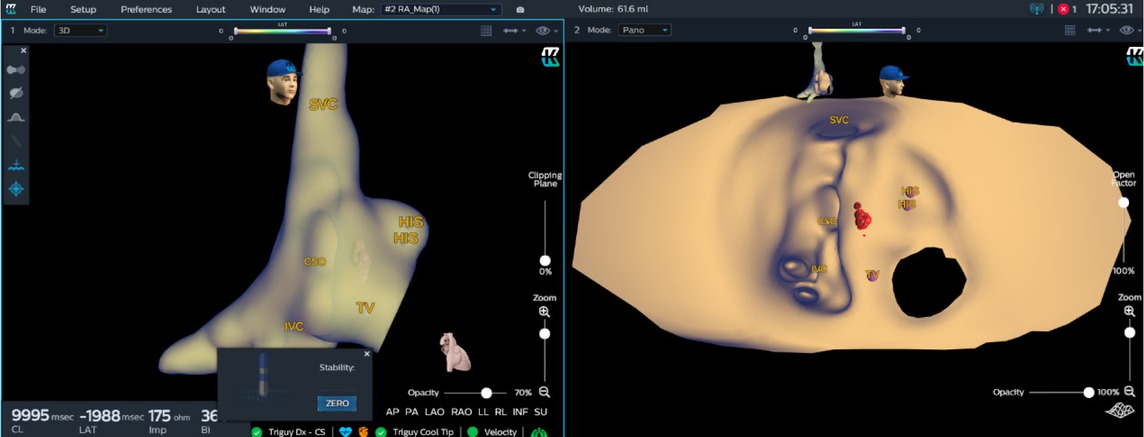 Figure 2 KODEX map of atrioventricular junctional region. Three-dimensional map (left) and PANO view (right) of right atrium and atrioventricular junctional region were presented. After isoprenaline infusion, a typical atrioventricular nodal re-entry tachycardia was induced. The position of His bundle, coronary sinus orifice and the ablation mark were clearly marked in PANO view to indicate the ablation tissue. After 1.5 minutes of ablation (35W, 55°C), the arrhythmia was successfully ablated. PANO view clearly showed the right atrial endocardial view of atrioventricular junctional region. CSO: coronary sinus orifice; HIS: His bundle; IVC: inferior vena cava; SVC: superior vena cava; TV: tricuspid valve.
