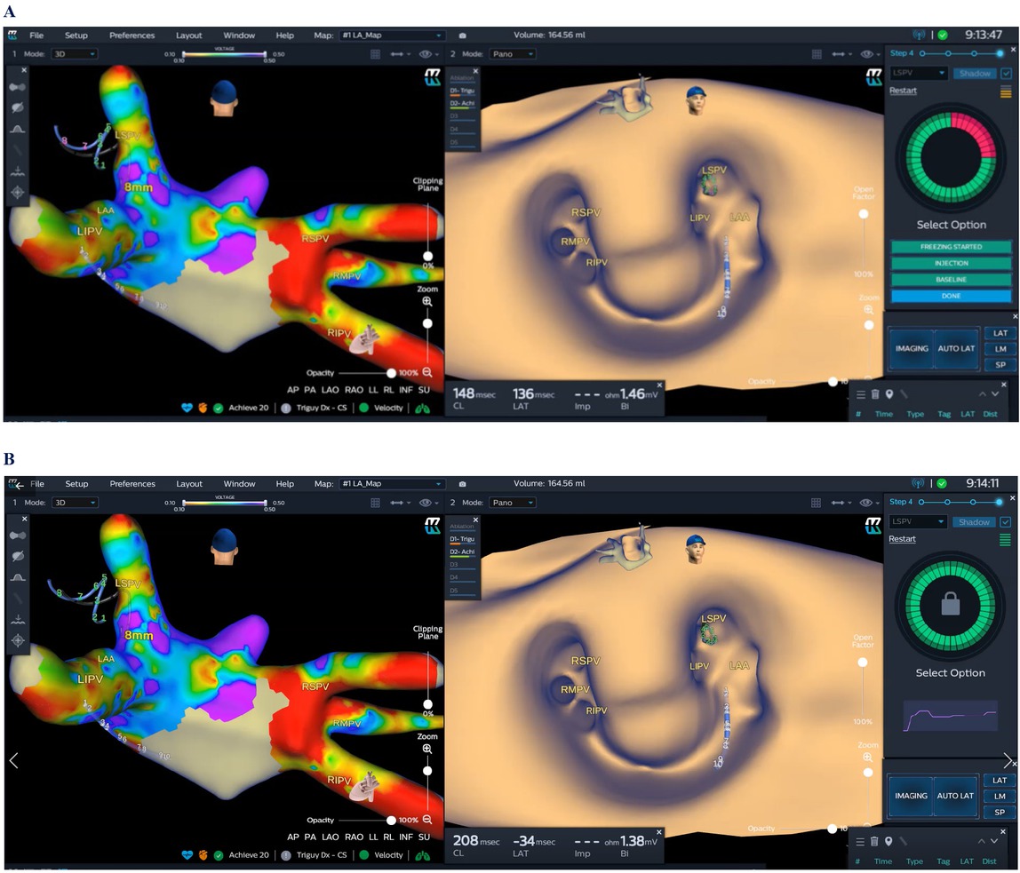 Figure 3 KODEX mapping for AF cryoablation. A 28 mm cryoballoon (Arctic Front Advance Pro; Medtronic), including the circular diagnostic catheter, was placed in the PV antrum. On the roof of the left atrium, there was a small diverticulum between the left and right superior PVs. Three branches were found for the right PV (left). When the cryoballoon occluded the pulmonary vein, “Select PV” displayed a circle with part of red color due to incomplete occlusion or leakage of contrast agent (A). If the PV was occluded completely, the “Select PV” displayed a circle of green color (B). AF: atrial fibrillation; PV: pulmonary vein; LAA: Left atrial appendage; LIPV: Left inferior pulmonary vein; LSPV: Left superior pulmonary vein; RIPV: Right inferior pulmonary vein; RMPV: Right middle pulmonary vein; RSPV: Right superior pulmonary vein.