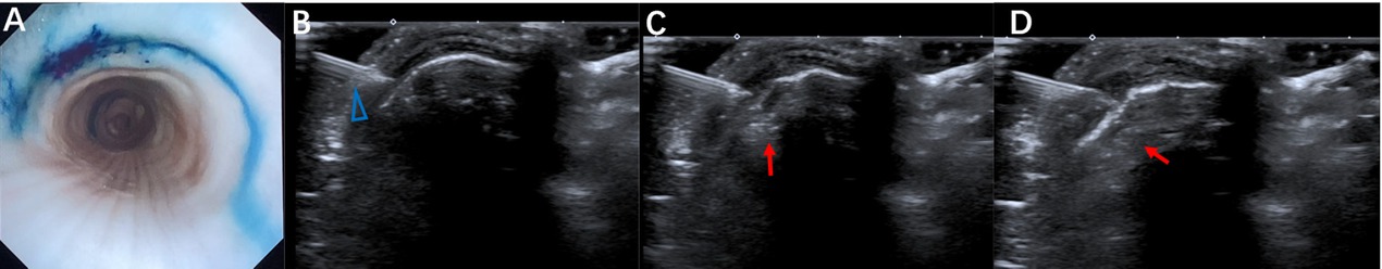 Figure 2 Correspondence of the bronchoscopic view of the inner tracheal wall with the submucosal injection of methylene blue guided by transcutaneous POCUS (A) Bronchoscopic manifestation of ex vivo porcine trachea after submucosal injection of methylene blue guided by transcutaneous POCUS. (B–D) The process of submucosal injection of methylene blue guided by POCUS. The blue triangle indicates the injection needle. The red arrow indicates the thickening of the submucosal layer with the medication injection. POCUS: point-of-care ultrasound.