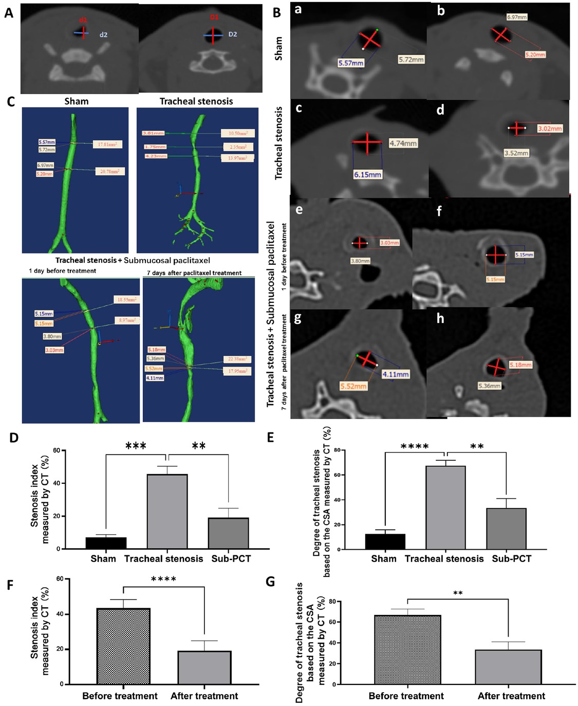 Figure 5 Comparison of diameters of the trachea on CT. (A) Mediastinum window of cervical CT showing the measurement of tracheal diameter at the location of the stenosis and the nearest normal tracheal ring. d1 and D1: the anteroposterior dimension; d2 and D2: transverse dimension. (B) Mediastinum window of cervical CT. a, c, e, and g show scans of the target site of the trachea, while b, d, f, and h show scans of the site of the nearest normal tracheal ring below the target site. Representative axial computed CT neck images in the tracheal stenosis group. Measurements of the tracheal diameter were taken in the AP and transverse dimensions; the cross-sectional area was determined with software by drawing an outline around the airway space at each level. (C) Three-dimensional reconstruction showing the CSA and diameters of the narrowest lumen. (D) Comparison of the severity of tracheal stenosis in different groups. Stenosis index based on the diameters measured by CT scan. (E) Comparison of SD% in different groups. (F) Comparison of the severity of tracheal stenosis in the treatment group before and after treatment. (G) Comparison of SD% in the treatment group before and after treatment. Values are expressed as the mean ± SEM (n = 5 rabbits/group). **P < 0.01, ***P < 0.001, and ****P < 0.0001. AP: anterior-posterior; CSA: cross-sectional area; CT: computed tomography; SEM: standard error of the mean; SD%: degree of tracheal stenosis.