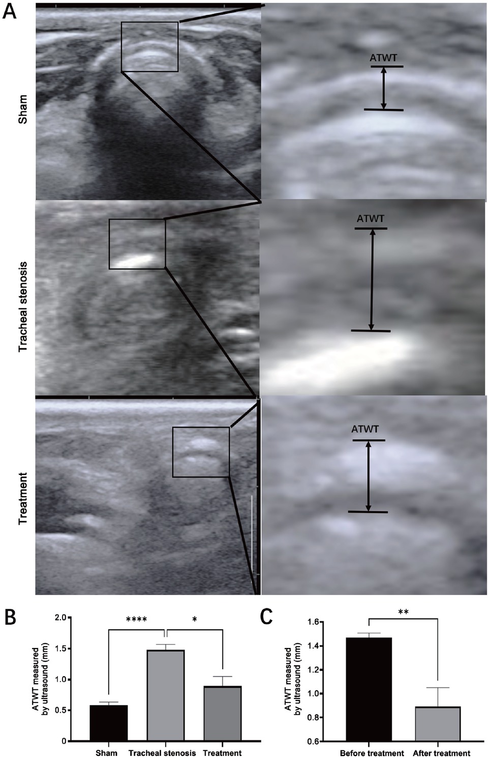 Figure 6 Comparison of ATWT measured by cervical ultrasound in the transverse plane. (A) Sonogram of the trachea by cervical ultrasound in the transverse plane and measurement of ATWT. (B) Comparison of ATWT in the sham group, tracheal stenosis group, and treatment group. (C) Comparison of the changes of AWAT before and after treatment. Values are expressed as the mean ± SEM (n = 5 rabbits/group). *P < 0.05, **P < 0.01, and ****P < 0.0001. ATWT: anterior tracheal wall thickness; SEM: standard error of the mean.