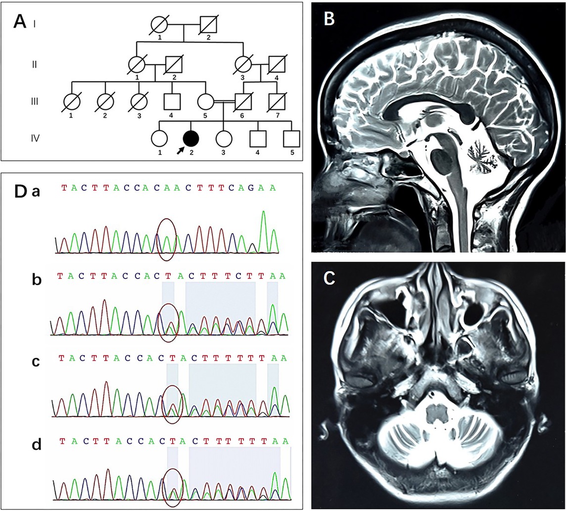 Figure 1 Pedigree, brain MRI, Sanger sequencing. (A) The proband (IV:2, arrow) was born to consanguineous parents (III:5 and III:6). (B and C) Brain MRI shows marked cerebellar atrophy. (D) Red circles indicate the site of mutation. Sanger sequencing confirmed that the proband (IV:2, a) was homozygous for the c.1213_1215delTTA (p. L405del) mutation of ANO10 and her mother (III:5, b), 28-year-old brother (IV:4, c), and 24-year-old brother (IV:5, d) were heterozygous carriers. MRI: magnetic resonance imaging.