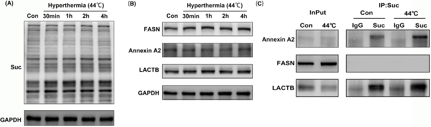 Figure 4
Hyperthermia increase the succinylation levels of total proteins in HaCaT cells. (A) Western blot analysis of the succinylation of total proteins in HaCaT cells in different time points after hyperthermia. (B) Western blot analysis of the expression of LACTB, FASN, and annexin A2 in HaCaT cells in response hyperthermia. (C) Co-immunoprecipitation analysis of the succinylation of LACTB, FASN, and annexin A2 before and after hyperthermia. Suc indicates the lysine succinylation. FASN: fatty acid synthase; LACTB: serine beta-lactamase-like protein; IgG: immunoglobulin G; GAPDH: glyceraldehyde-3-phosphate dehydrogenase.