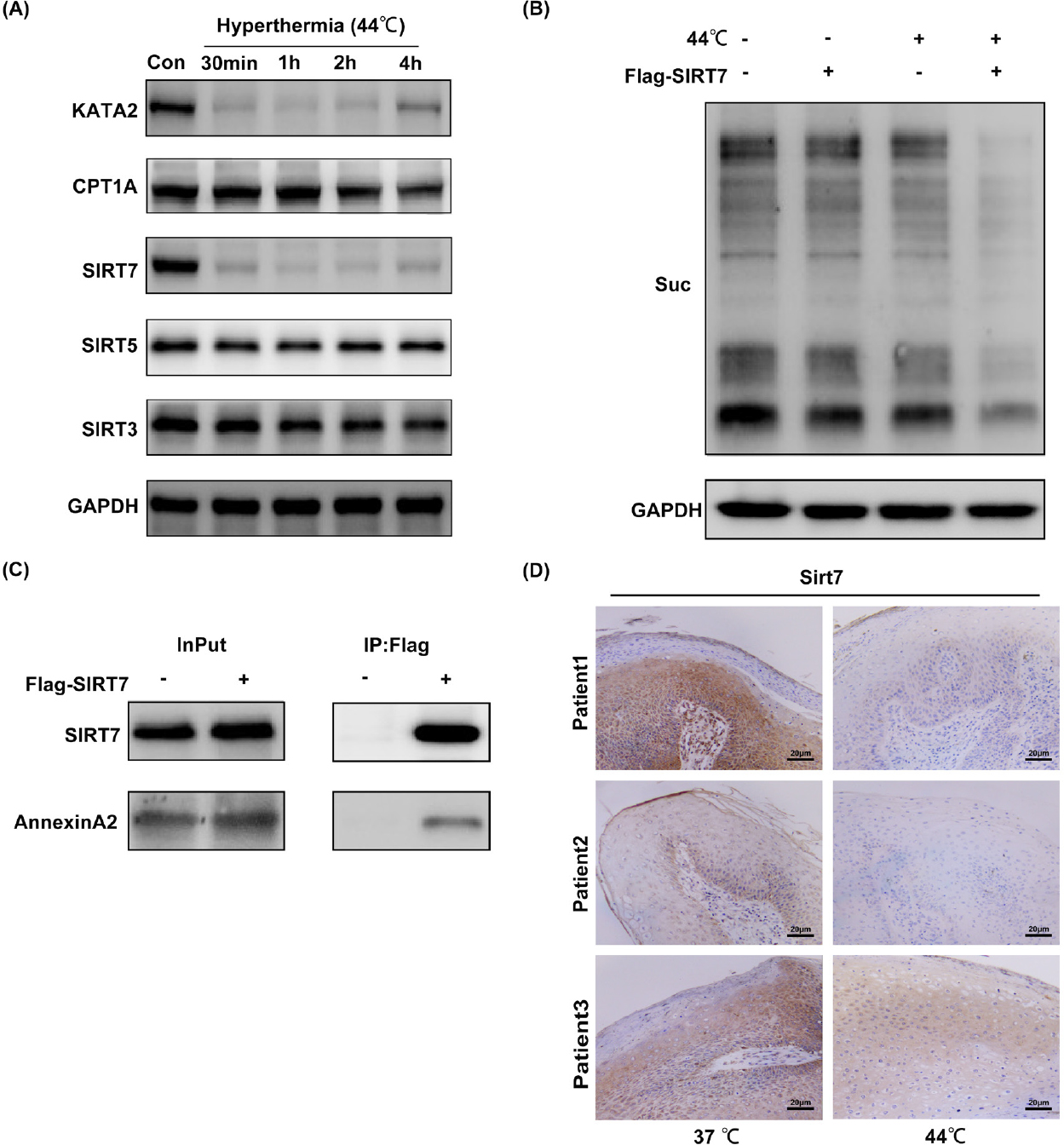 Figure 5
Hyperthermia influencing the succinylation of global proteins by downregulating SIRT7 in HaCat cells. (A) Western blot analysis of the expression of succinylated enzymes after hyperthermia. (B) Western blot analysis of the succinylation of global proteins in overexpression SIRT7. (C) Co-immunoprecipitation analysis of the interaction of SIRT7 with LACTB, FASN, and annexin A2. (D) The immunohistochemical staining of SIRT7 in condyloma acuminatum tissues. Suc indicates the lysine succinylation. - means empty vector plasmid. + means SIRT7 plasmid. Original magnification: 200×. FASN: fatty acid synthase; SIRT7: sirtuin7; LACTB: serine beta-lactamase-like protein; GAPDH: glyceraldehyde-3-phosphate dehydrogenase.