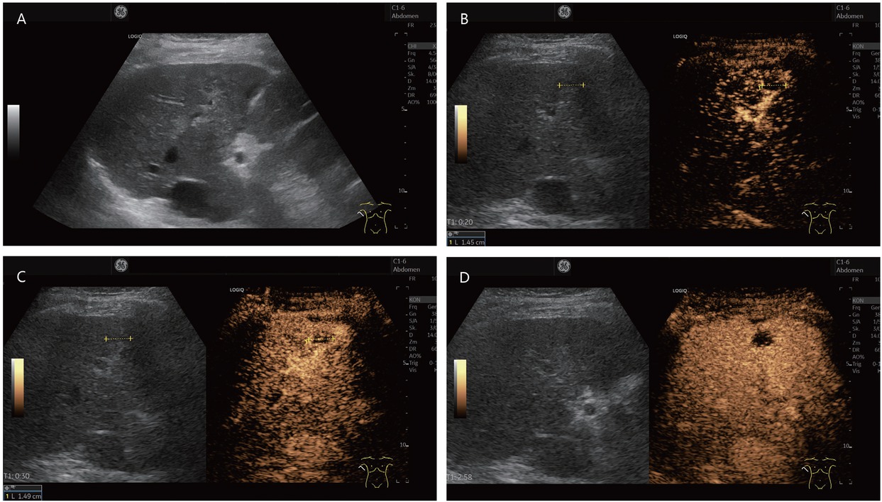 Figure 1 An 80-year-old female presented with thrombosed hemangioma (in between markers) and liver cirrhosis after hepatitis C infection. She had normal AFP and no previous known tumor disease. Hypoechoic inhomogeneous liver lesion with echogenic rim on B-mode ultrasonography (A). No enhancement in the arterial phase, only suggested rim (B). At the beginning of the portal venous phase, the lesion is not enhanced, except for a few vascular pixels. These are seen in the marginal area and cannot be clearly assigned for differential diagnosis (C). In the late CEUS phase, the lesion remains completely avascular. A retraction of the liver contour is seen above the lesion. On MRI, the lesion was assigned as a thrombosed hemangioma. Thrombosed hemangioma with capsular retraction is a finding that has been described on MRI for hemangiomas in liver cirrhosis. Capsular retraction can also be seen in tumors (D). CEUS: contrast-enhanced ultrasonography; MRI: magnetic resonance imaging; AFP: alpha-fetoprotein.
