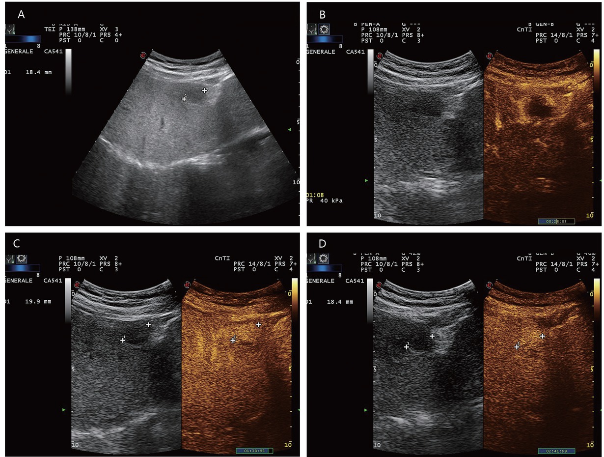 Figure 2 A 65-year-old male with diabetes and past history of obesity. Hemangioma (in between markers) on the background of steatosis hepatis with severe fibrosis at shear wave elastography (9.5 kPa). Hypoechoic liver lesion in B-mode ultrasonography (A). On CEUS, smooth annular enhancement in the arterial phase (B). Smooth contrast medium lake in the marginal area in the portal venous phase (C). Complete centripetal filling in the late phase (D). Here typical hemangioma. CEUS provides the exact differential diagnostic assignment of a hypoechoic liver lesion in liver cirrhosis and makes further contrast-enhanced radiologic diagnostics unnecessary. CEUS: contrast-enhanced ultrasonography.
