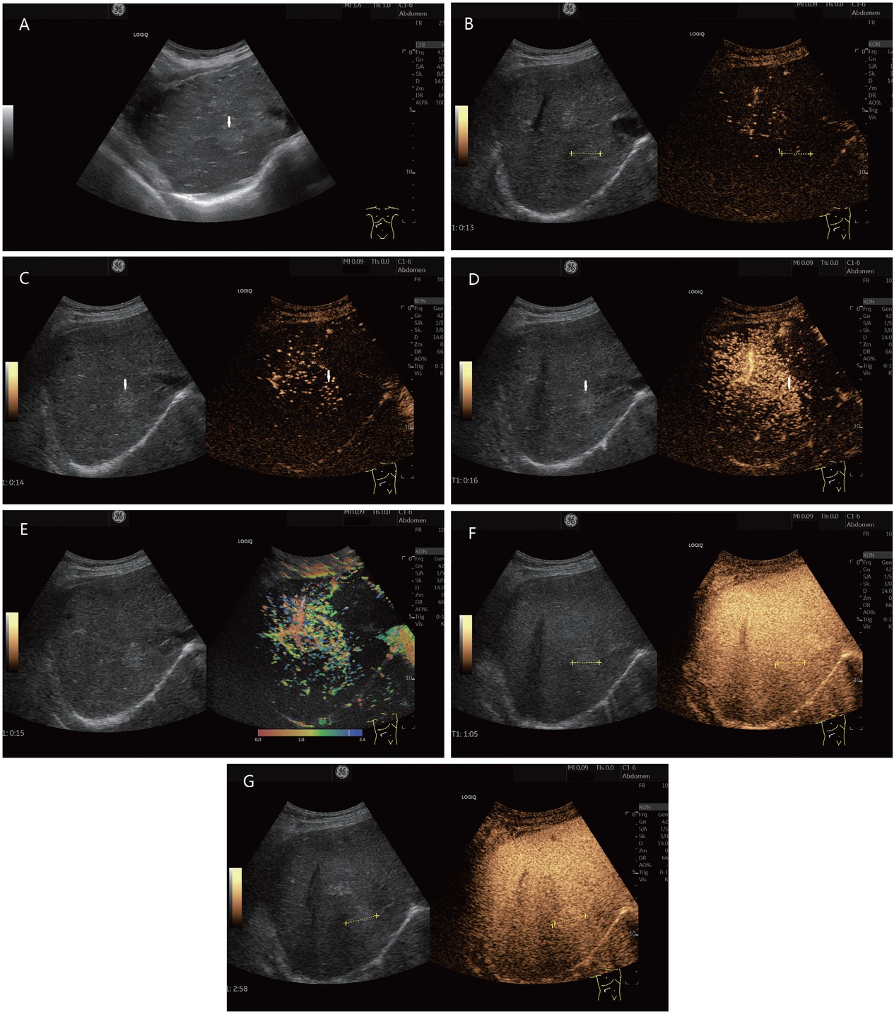 Figure 3 FNH or FNH-like lesion (histologically proven). In a 78-year-old female, ascites was diagnosed during gynecological examination. Further diagnosis revealed cirrhosis cardiac with a liver lesion. A 22-mm, slightly hyperechoic lesion was located in the right liver lobe adjacent to the inferior vena cava (in between markers and shown by arrows). This is shown on B-mode ultrasonography (A). A central vessel is visible on CEUS at the beginning of the arterial phase. The lesion is marked in the dual measurement (B). In the arterial phase, an evenly distributed contrast uptake is seen in the further course (C). The lesion is homogeneously enhanced. Increased contrast is conspicuous adjacent to the caudal part of the liver. Here, the contrast of a strong arterial vessel is visible (D). These phenomena are also seen in parametric imaging (E). In the portal venous phase (F) and late phase (G), the lesion remains hyperenhanced to the surrounding liver parenchyma. This was considered benign. On MRI, the lesion could not be clearly classified. Due to the hyperenhancement in the arterial phase and the diffusion disturbance in the MRI, the lesion remained suspicious. A sonographic guide biopsy was performed. The histology described an FNH. Follow-up over 6 months showed no change in findings. CEUS: contrast-enhanced ultrasonography; MRI: magnetic resonance imaging; FNH: Focal nodular hyperplasia.