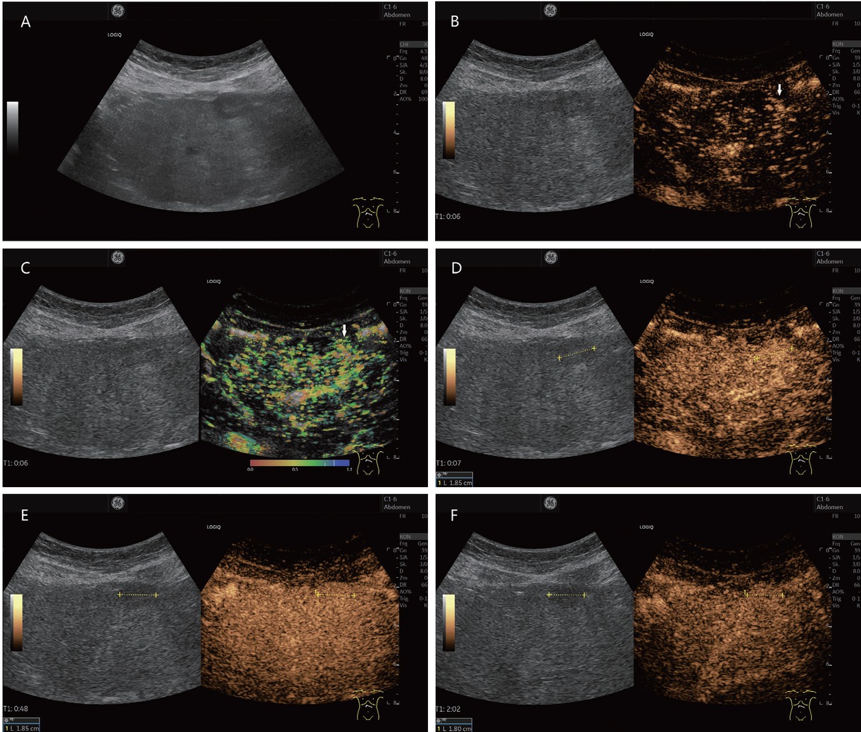 Figure 4 A 38-year-old female presented with suspected FNH-like nodule, alcohol toxic cirrhosis (in between markers and shown by arrows). She had a history of continued alcohol abuse and had untreated hepatitis B and hepatitis C. She had undergone repeated hospitalizations with ascitic decompensation. Newly diagnosed hepatic lesion not present 6 months previously on B-mode ultrasonography (A). In CEUS, wheel spoke enhancement early arterial (B), corresponding temporal mapping also in parametric imaging (C). The lesion was enhanced in the arterial phase (D), isoenhanced or slightly hyperenhanced in the portal venous phase (E), and slightly hyperenhanced in the late phase (F). The lesion also remained iso- to slightly hyperenhanced in the further course of examination until 3 min p.i. MRI also showed an APHE hepatic lesion. The wheel spoke enhancement and persistent hyperenhancement on CEUS were suggestive of FNH. However, a corresponding lesion was not pre-documented. Therefore, sonographically assisted biopsy with 4× percutaneous access was performed. This did not result in a definitive diagnosis – no HCC, but also no FNH. The CEUS findings were compatible with an FNH. Since the lesion was not known before, it could be in the overall context with an FNH-like nodule. The contrasting course in the CEUS argues against a regenerated node. On further hospitalization with ascitic decompensation, the lesion remained unchanged and the AFP was normal even after 6 months. FNH: focal nodular hyperplasia; CEUS: contrast-enhanced ultrasonography; APHE: arterial phase hyperenhancement; HCC: hepatocellular carcinoma; MRI: magnetic resonance imaging; AFP: alpha-fetoprotein.