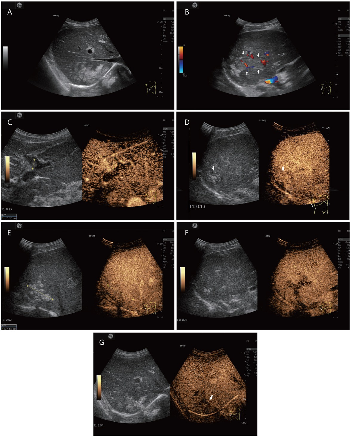 Figure 5 Liver metastases in a liver cirrhosis (histologically confirmed [in between markers and shown by arrows]). A 78-year-old male presented with hepatitis B and C and a history of continued alcohol abuse and operated sigmoid carcinoma. He currently had a peripheral lung lesion. AFP was normal. Computed tomography demonstrated hypodense liver lesions. Sonographically, irregularly circumscribed hyperechogenic liver lesions are seen subdiaphragmatically in the right liver lobe in B-mode (A). Adjacent to this, the right posterior branch of the ramus principalis is dilated and filled with thrombi (B). There is also a small thrombus in the pars umbilicalis, which is hyperenhanced in the arterial phase in CEUS, and thus corresponds to a tumor thrombus (C). On CEUS, the hyperechogenic lesions in the right hepatic lobe are isoechogenic, slightly inhomogeneously enhanced in the arterial (D) and portal venous (E) phases. The adjacent thrombosed portal venous branch is hypoenhanced (F). In the late phase, the liver lesions are hypoenhanced (G). CEUS was used to perform ultrasonography-guided puncture of the liver lesions and the thrombosed portal vein branch. Histologically, a metastasis of the sigmoid carcinoma was found. There was no evidence of hepatocellular carcinoma. CEUS: contrast-enhanced ultrasonography; AFP: alpha-fetoprotein.