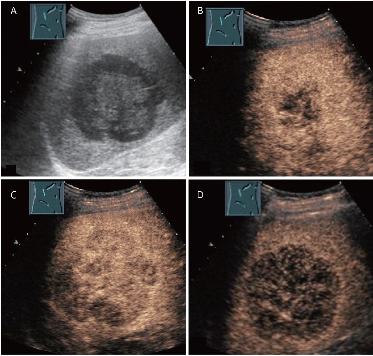 Figure 7 Diffuse large cell non-Hodgkin’s lymphoma and alcoholic liver cirrhosis of Child–Pugh class B in a 74-year-old male. Large hypoechoic mass in segment 5/6 on B-mode ultrasonography (A). On contrast-enhanced ultrasound, the lesion showed an inhomogeneous, nearly isoechoic enhancement after 15 s (B), with hypoenhancement after 30 s (C) and 3 min (D). A biopsy of the lesion revealed a diagnosis of diffuse large cell non-Hodgkin’s lymphoma. After chemotherapy, a complete regression of the tumor was observed.