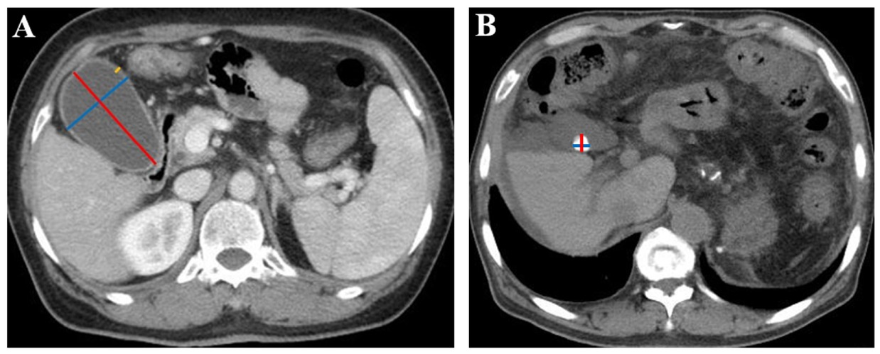 Figure 1 Gallbladder and gallstone parameters measured in CT images. (A) Measurement of gallbladder parameters in a 63-year-old woman with liver cirrhosis. The red line represents the maximum gallbladder length, the blue line represents the maximum gallbladder width, and the yellow line represents the maximum gallbladder wall thickness. The maximum gallbladder length was 77.6 mm, the maximum gallbladder width was 49.0 mm, and the maximum gallbladder wall thickness was 3.5 mm. (B) Measurement of gallstone parameters in a 65-year-old man with liver cirrhosis. The red line represents the maximum gallstone length, and the blue line represents the maximum gallstone width. The maximum gallstone length was 12.7 mm, and the maximum gallstone width was 12.4 mm. CT: computed tomography.