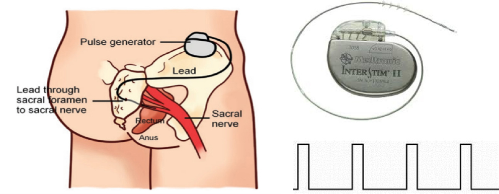 Figure 2 Sacral nerve stimulation for fecal incontinence. Left: embodiment of the stimulation lead and pulse generator; top right: Implantable pulse generator connected with stimulation lead from Medtronic Inc; bottom right: continuous stimulation pulses used for treating fecal incontinence.
