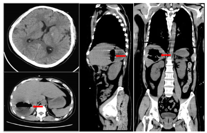 Figure 1 
Initial brain CT scan shows no abnormalities, while sagittal and axial abdominal CT scans reveal a hepatic abscess with high gas and fluid levels in the right lobe. Red arrow: a large amount of gas is seen in the cavity of the liver abscess. CT: computed tomography.
