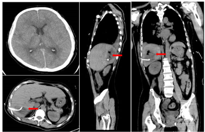 Figure 2 
Repeat CT scans on day 2 reveal emerging cerebral edema and subarachnoid hemorrhage, but there is a decrease in hepatic gas and fluid levels. Red arrowhead: after liver abscess puncture drainage, the gas in the abscess cavity had decreased obviously. CT: computed tomography.
