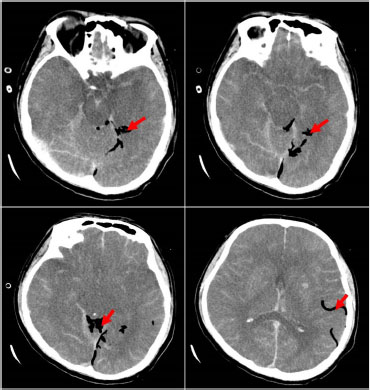 Figure 4 
CT scan on day 5 showing exacerbated brain swelling, cerebral herniation, and emerging pneumocrania. Red arrow: visible intracranial pneumatosis. CT: computed tomography.
