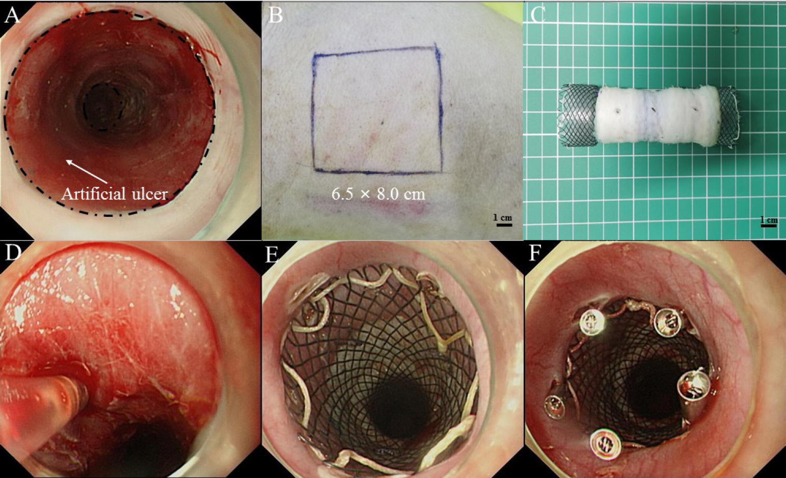 Figure 1 
Artificial circumferential mucosal defect followed by endoscopic injection of PRP and transplantation of ASG. (A) Artificial circumferential mucosal defect on esophagus (5 cm in length). (B) Split-thickness skin graft was harvested from the right back of the pig. (C) The graft was sewn into an “oversleevelike” skin and was covered the outside of esophageal stent. (D) Submucosal injection of PRP. (E) The stent was placed at the location of the esophageal defect. (F) Using endoscopic clips to fix the stent. PRP: plasma-rich platelet; ASG: autologous skin graft.
