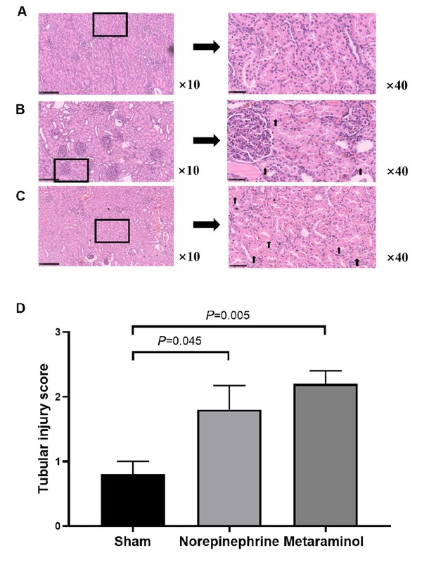 Figure 6 Cardinal features of acute kidney injury. Representative histology and pathological scores of tubular injury in kidney cortex by HE staining in sham group (A), norepinephrine group (B) and metaraminol group (C). The arrows indicate magnified views of the tubular injury. D. The tubular injury score in three groups.