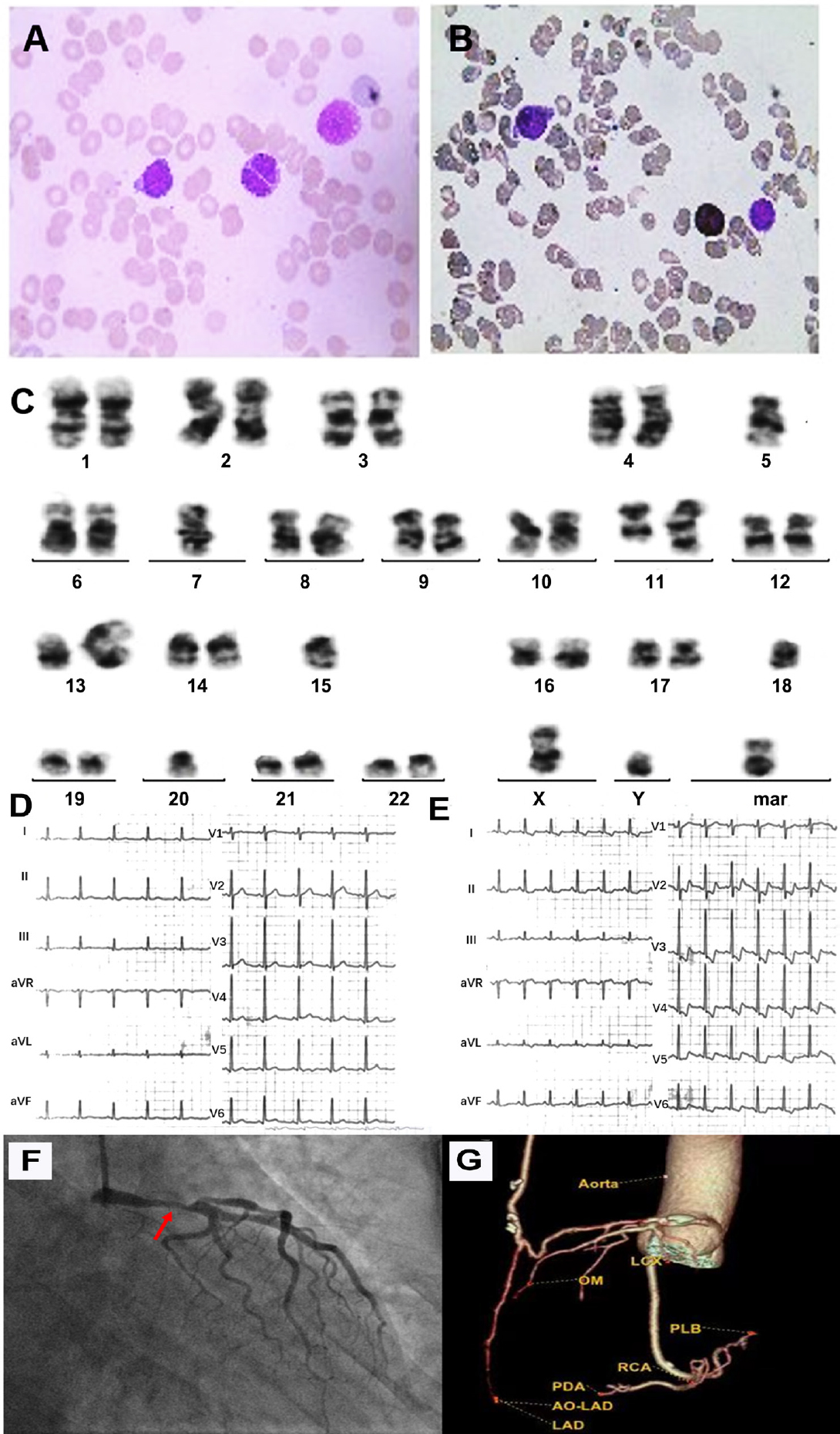 Figure 1 
(A) The bone marrow cell morphology of the patient at diagnosis. (B) Peroxidase (POX) staining of bone marrow cells: the cells stained positive for POX. (C) Cytogenetic analysis at diagnosis of the patient: 39-42, XY, add (3)(q21)[2],-5[16],-7[16], inv (9)(q13; q34)[6], +inv (9)(q13q34)[4], dup (11)(q13q23) [6], der (13; 15)(q10; q10)[16],-18 [16],-20 [8], del (20)(q11)[5],-21 [10], +mar1[12], +mar2 [4][cp16] /46, XY[4]. ECG before (D) and after (E) exercise showed that ST segment elevation in aVR lead and ST segment depression in V2-V6 leads after exercise. (F) Coronary angiography showed that the patient had severe stenosis (50%-90% x 15 mm) with plaque in his left main coronary artery. (G) Coronary CT angiography showed that the bypass artery was unobstructed.
