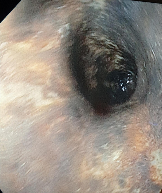 Figure 1
“Black eosophagus”, extensive necrotic lesions along the entire length of the esophagus.