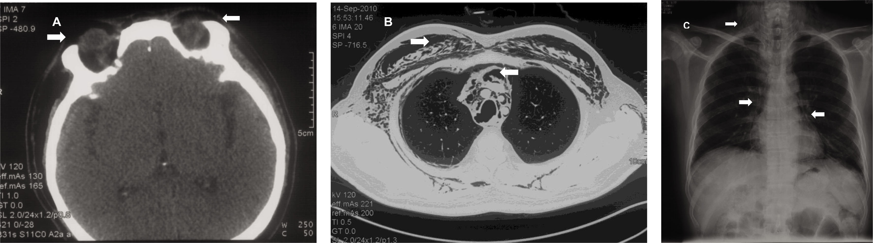 Figure 1 Panel A: A chest X ray demonstrated signs of pneumomediastinum (arrow) and subcutaneous emphysema (arrowhead) for this patient with dermatomyositis. Panel B: A Chest CT scan demonstrated signs of pneumomediastinum (arrow) and subcutaneous emphysema (arrowhead) for the patient with dermatomyositis. The bilateral lung fields were otherwise clear. Panel C: On a head CT scan, air was identified in the periorbital and tempus region (arrows).