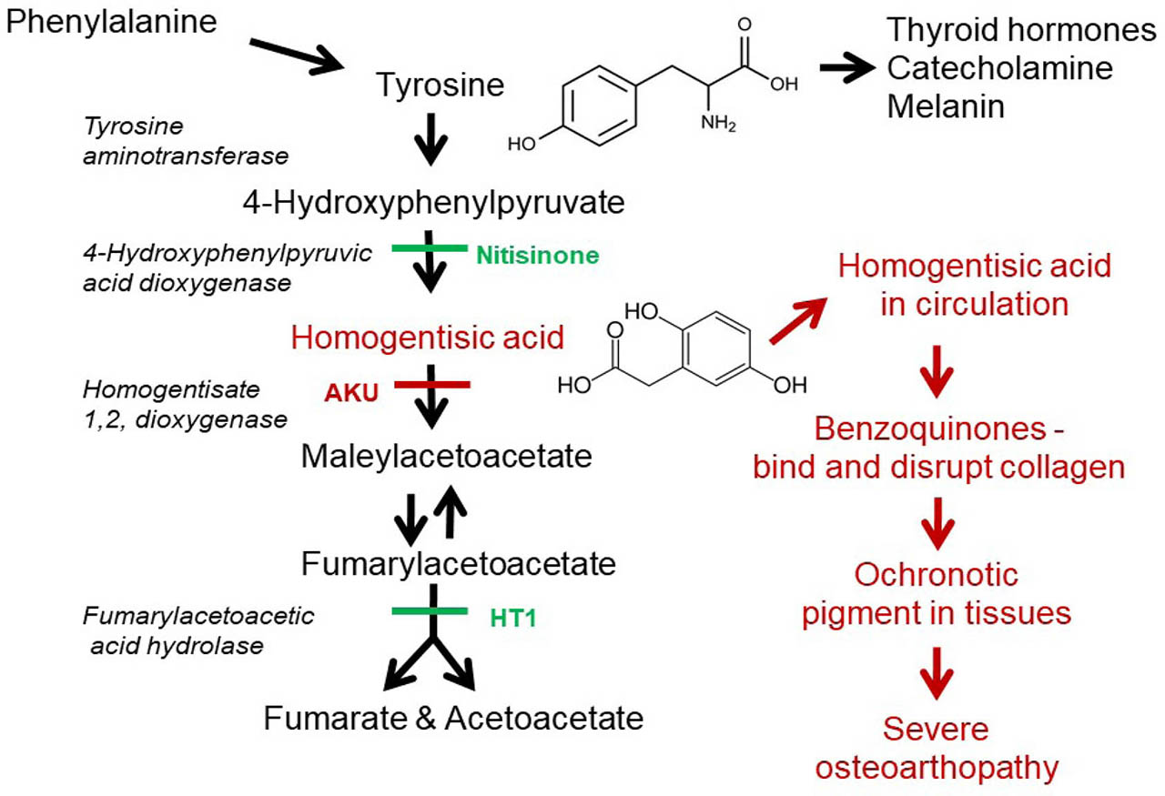 Figure 1 Tyrosine metabolic pathway highlighting the enzyme defects responsible for AKU and HT1, the putative ochronotic pathway, and the site of action of nitisinone. AKU, alkaptonuria; HT1, hereditary tyrosinaemia 1.
