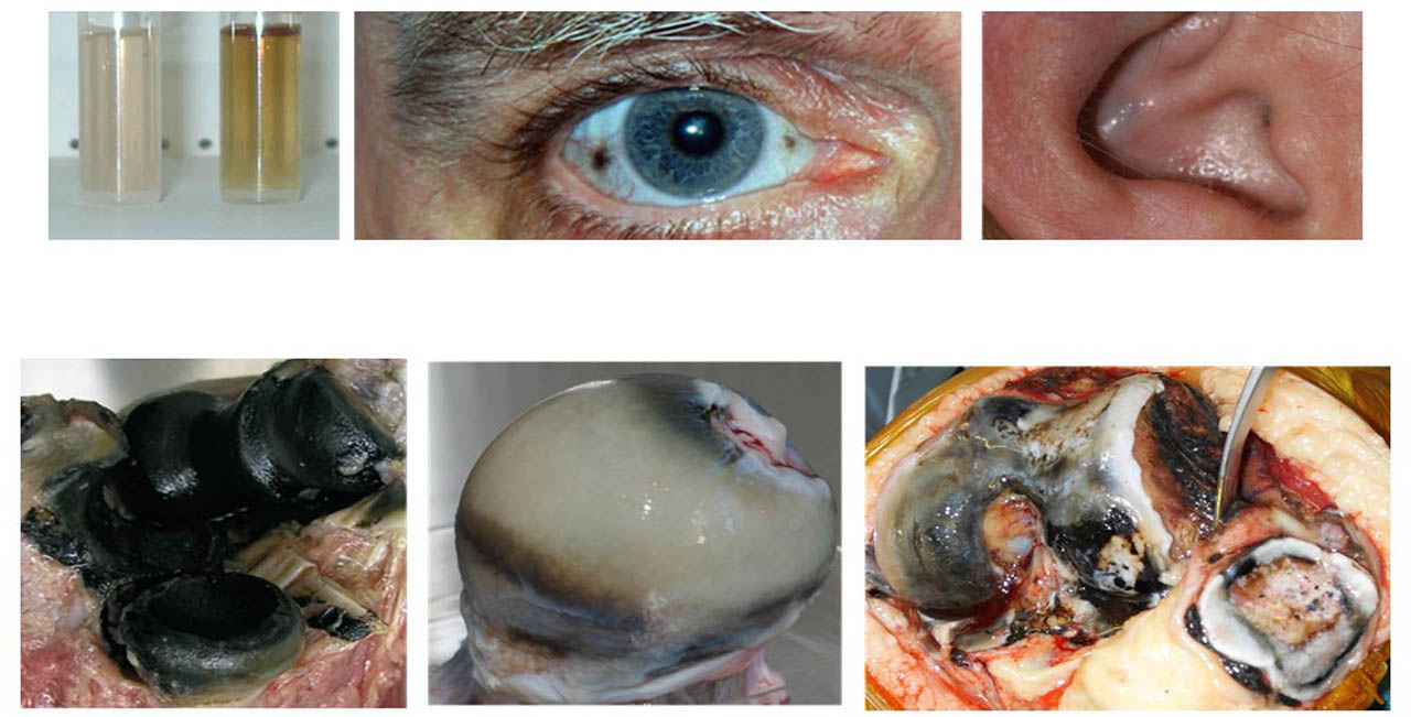 Figure 2 Pigmentation and ochronosis in AKU. Upper left panel, darkening of AKU urine following addition of alkali. Upper central panel, ochronotic pigmentation of the sclera of the eye. Upper right panel, darkening of the conchal bowl of the external ear due to ochronosis of the underlying elastic cartilage. Lower left panel, an elbow joint observed at autopsy (adapted with permission from Ref. 10). Lower central panel, a femoral head removed from a patient because of persistent lancinating pain. Pigmentation is most intense in the deeper layers of the cartilage. The cartilage is generally intact. Further study of this sample with advanced imaging techniques lead to the identification of HDMPs shown in Figure 5. Lower right panel, a photomicrograph taken during knee replacement surgery (adapted with permission from Ref. 17). There is pigmentation of the femoral, tibial, and patellar hyaline cartilages. Areas of cartilage fragmentation and loss can be observed on the surface of the femur of the articular cartilage. AKU, alkaptonuria; HDMPs, high-density mineralized protrusions.
