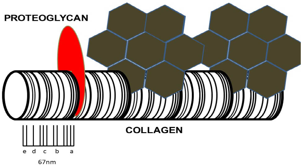 Figure 3 The exposed collagen hypothesis. Schematic representation of collagen fibril with characteristic periodicity. On the left-hand side, the collagen fibril is decorated with a protective proteoglycan molecule (red). Further along the fibrils, proteoglycans have been lost as a result of repetitive mechanical loading, chemical attack, or aging and degeneration. This has allowed HGA to bind to the exposed aspects of collagen fibril. The initial binding of HGA functions as a nucleation event and is followed by further rapid deposition of HGA as a pigmented polymer. Binding of HGA-derived pigment to the collagen fibrils makes them stiffer and susceptible to more mechanical damage. This leads to further ultrastructural changes in collagen, increased exposure to HGA, and a downward spiral of increasing pigmentation (adapted with permission from Ref. 17). HGA, homogentisic acid.