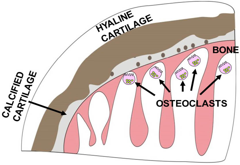 Figure 4 Schematic representation of joint destruction in ochronosis. Ochronosis begins with the deposition of pigment in individual chondrocytes and their territorial matrix in calcified cartilage. Pigmentation then proliferates throughout the hyaline cartilage. Ochronotic cartilage shields the underlying bone from normal mechanical loading leading to aggressive resorption of the subchondral plate and underlying trabeculae by osteoclasts. Despite the increased stiffness, the pigmented shell of the remaining articular cartilage fails catastrophically.