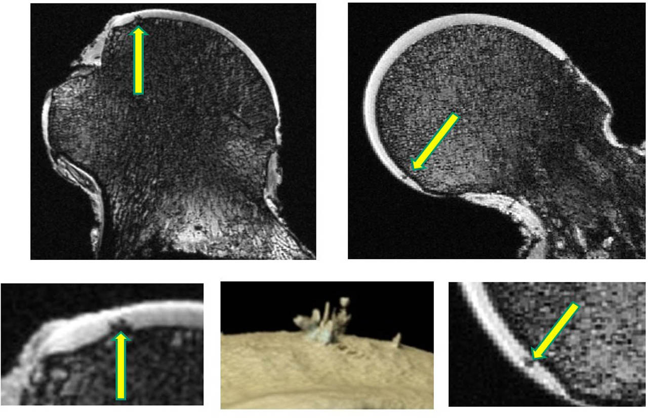Figure 5 HDMPs in AKU and non-AKU femoral heads. Upper left panel, MRI slice through the femoral head of a 49-year-old male patient with AKU obtained with an isotropic dual-echo steady-state (DESS) sequence with a resolution of 0.23 mm. Note a region of hypointensity within the hyaline cartilage that corresponds to the position of the HDMPs. Upper right panel, MRI image of a femoral head from an 87-year-old non-AKU male showing a hypointense HDMP (arrow). The lower right and left panels show the HDMPs at higher magnification. The lower central panel shows a 3D micro-computerised tomography (CT) image of HDMPs from the AKU sample (adapted with permission from Boyde et al.[33]). AKU, alkaptonuria; HDMPs, high-density mineralized protrusions.