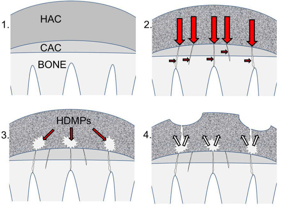 Figure 6 Formation of high-density mineralized protrusions (HDMPs). (1) Diagram of hyaline articular cartilage (HAC), calcified cartilage (CAC), and underlying subchondral and trabecular bone prior to degeneration. The subchondral plate is intact. (2) Collagen in cartilage becomes pigmented (represented by shading) and stiffened leading to aberrant transmission of mechanical loading (large red arrows). Repetitive loading leads to cracking of the subchondral plate (small red arrows). In addition, dysregulated remodeling of underlying bone leads to focal sclerosis and lysis. (3) Extrusion of mineralizable matrix through the cracks leads to the formation of HDMPs (white). (4) HDMPs are sharp, abrasive, and brittle leading to extensive mechanical destruction of the hyaline cartilage (small white arrows) (adapted with permission from Ref. 17).