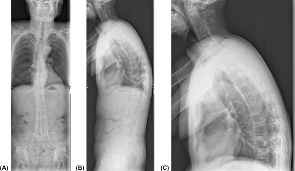 Figure 1 Full spine X-ray showed the patient's spinal changes. From the full spine X-ray, thoracic kyphotic deformity and bamboo-like changes in the thoracolumbar spine were observed. The lower edge of T10 vertebral body and the upper edge of T11 vertebral body showed bone destruction. The structure of attachment area bone was disordered and the density was uneven. The bilateral sacroiliac joint space had disappeared, the bilateral hip joints were narrowed and bilateral femoral head was necrotized. (A) Full Spine X-ray (PA); (B) Full Spine X-ray(LAT); (C) T-Spine X-ray (LAT).
