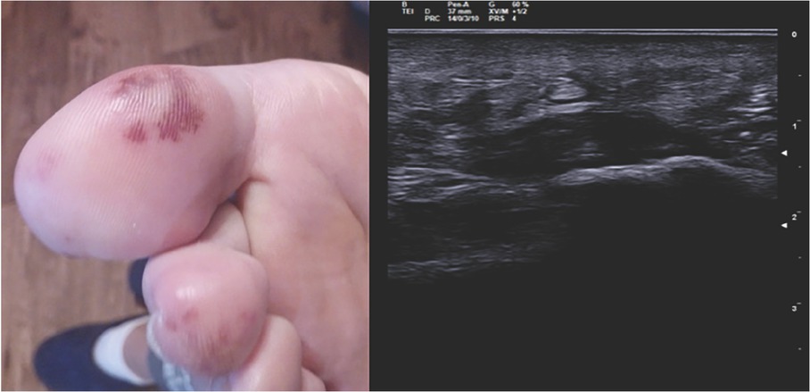 Figure 1 Purpuric lesions on the plantar side of the right foot (left). Echographic image of plantar fascia edema of the left foot (transverse section) (right).