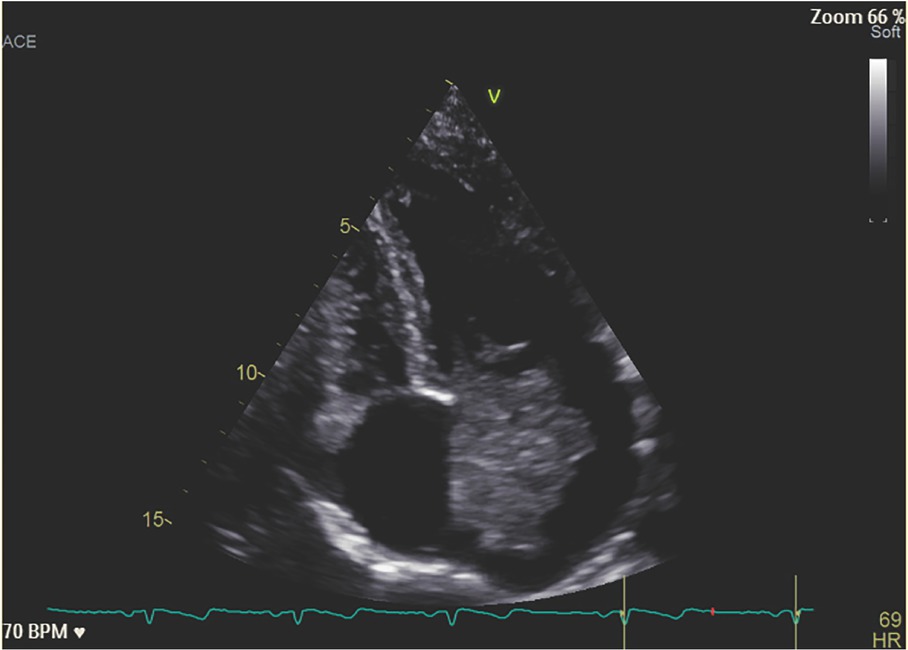 Figure 2 Echocardiographic image of the AM occupying almost all the left atrium and mitral valve. AM, atrial myxoma.