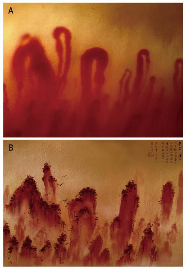 Figure 1 Nailfold capillary of the patient. (A) Nailfold capillaroscopy image of SSc patient; (B) Reproduction of (A) in traditional Chinese painting.