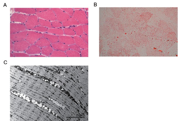 Figure 1 Pathological findings from left quadriceps muscle biopsy in this patient. (A) Varying sizes lipid vacuoles within muscle fibres (HE staining, × 400). (B) Lipid particle deposition within muscle fibres (ORO staining, × 400). (C) Electron microscopy showing lipid droplet deposition within muscle fibres.