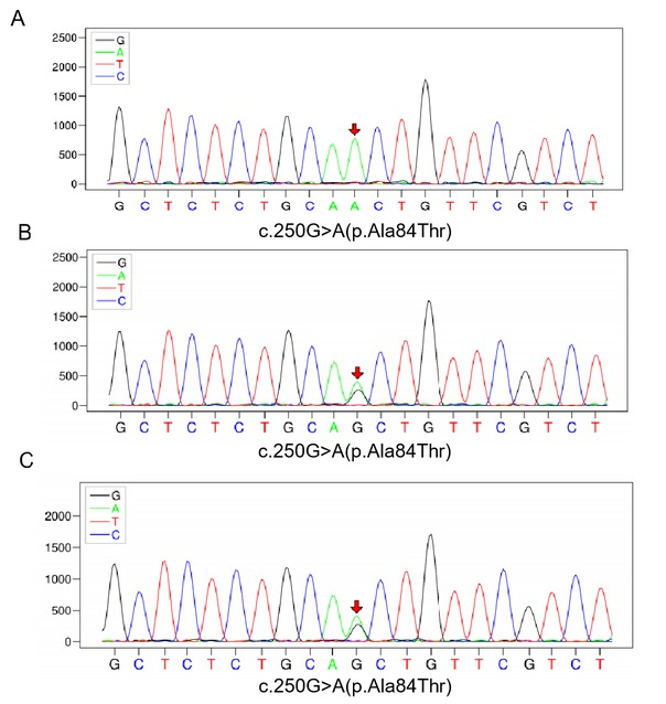 Figure 2 Sequencing of the electron transfer flavoprotein dehydrogenase gene of the patient (A), her father (B), and her mother (C), showed the same missense mutation of c.250G>A (p.Ala84Thr ) in chr4-159603421. The mutation was homozygous, while in her parents it was heterozygous.