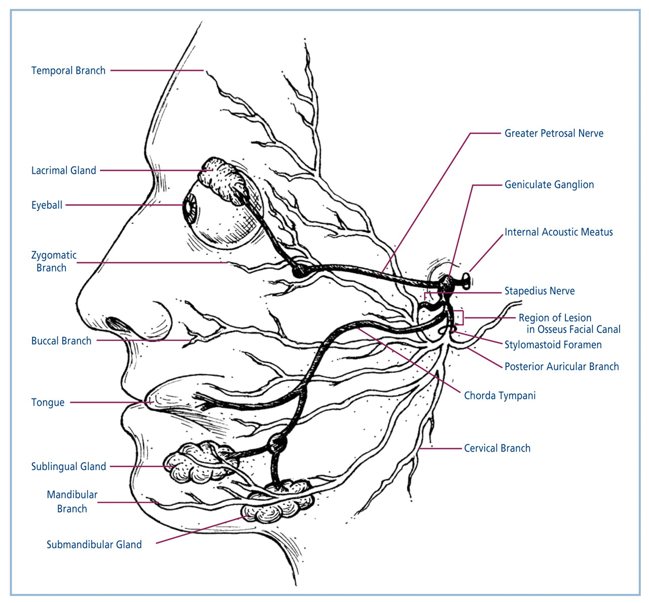 Figure 3.
A lesion along the intratemporal course of the facial nerve within the osseous facial canal is believed to be responsible for Bell's palsy. Intraosseous branches of the facial nerve include the greater petrosal nerve, the stapedius nerve, and the chorda tympani. The six terminal branches of the facial nerve are the buccal, cervical, mandibular, posterior auricular, temporal, and zygomatic branches.