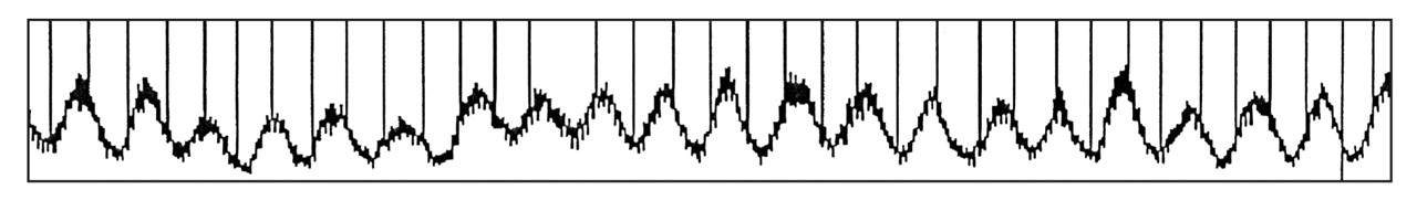 Figure 3.
Traube-Hering oscillation and cranial rhythmic impulse (palpation of flexion/extension) in a 1:1 ratio.